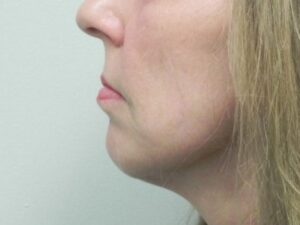 After Image: Chin Augmentation