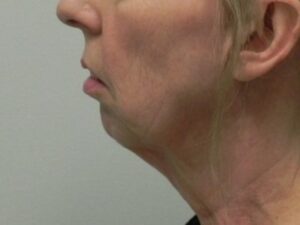 Before Image: Chin Augmentation