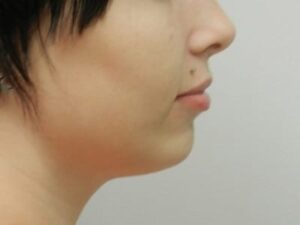 After Image: Chin Augmentation