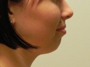 Before Image: Chin Augmentation