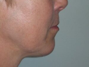 After Image: Chin Augmentation