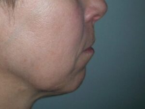 Before Image: Chin Augmentation
