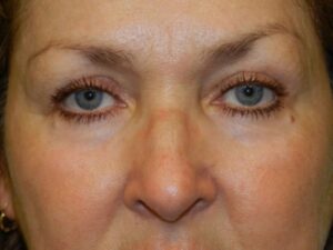 After Image: Eyelid Surgery and Laser Resurfacing