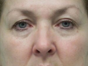 Before Image: Eyelid Surgery and Laser Resurfacing