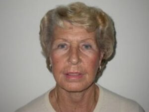 After Image: Facelift with Dr. Chiaramonte