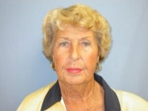 Before Image: Facelift with Dr. Chiaramonte