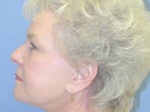 After Image: Face and Neck lift with Dr. Chiaramonte