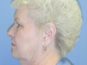 Before Image: Face and Neck lift with Dr. Chiaramonte