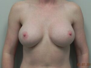 After Image: Implant Exchange