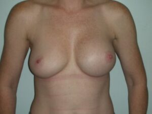 Before Image: Implant Exchange