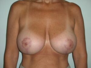 After Image: Implant Exchange