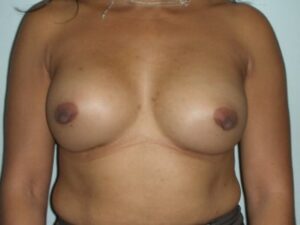 Before Image: Implant Exchange