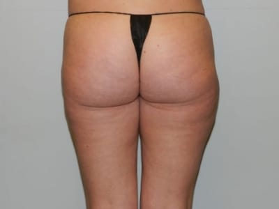 After Image: Liposuction - back