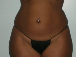 Before Image: Liposuction