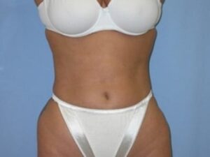 After Image: Liposuction