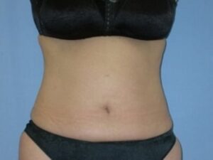 Before Image: Liposuction