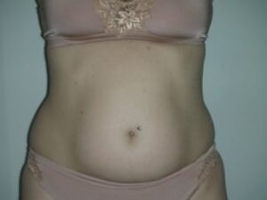 Before Image: Liposuction