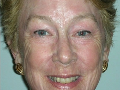 After Image: Laser Resurfacing - front