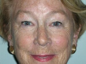 Before Image: Deep Laser Resurfacing