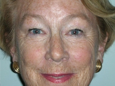 Before Image: Laser Resurfacing - front