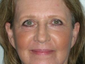 After Image: Deep Laser Resurfacing