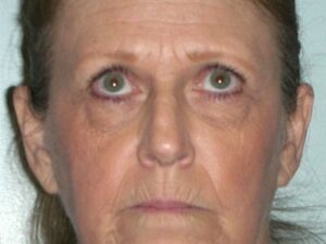 Before Image: Deep Laser Resurfacing