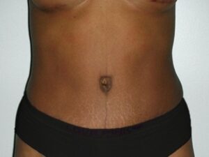 After Image: Mommy Makeover