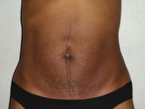 Before Image: Mommy Makeover