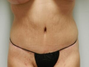 After Image: Mommy Makeover