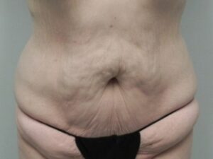 Before Image: Mommy Makeover