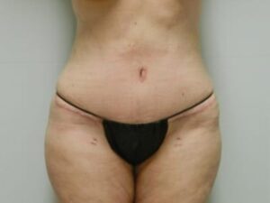 After Image: Mommy Makeover