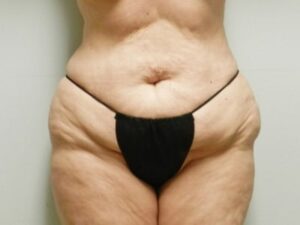 Before Image: Mommy Makeover