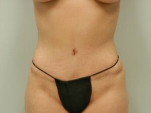 After Image: Mommy Makeover