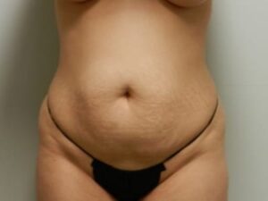 Before Image: Mommy Makeover