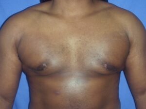 After Image: Male Breast Reduction