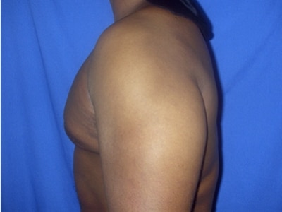 After Image: Male Breast Reduction - left-side