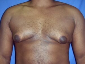 Before Image: Male Breast Reduction