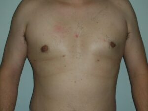 After Image: Male Breast Reduction