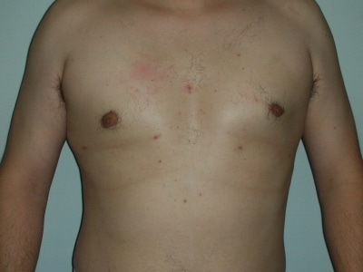 After Image: Male Breast Reduction - front