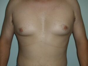Before Image: Male Breast Reduction
