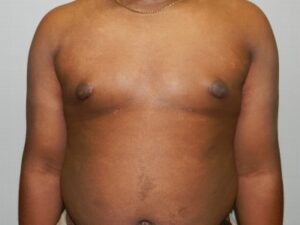 After Image: Male Breast Reduction