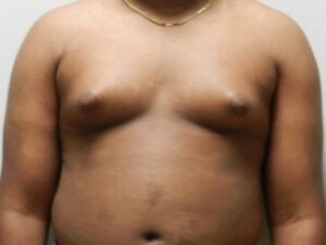 Before Image: Male Breast Reduction