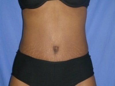 After Image: Tummy Tuck - front