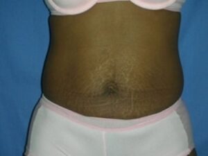Before Image: Tummy Tuck