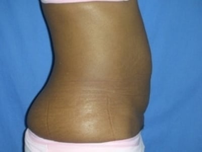 Before Image: Tummy Tuck - right-side