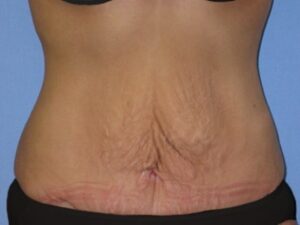Before Image: Tummy Tuck