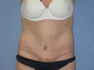After Image: Tummy Tuck