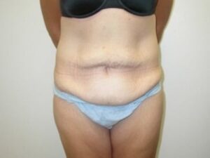Before Image: Tummy Tuck