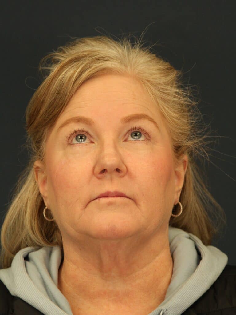 After Image: Upper Eyelid Lift & Facial Fat Grafting - front