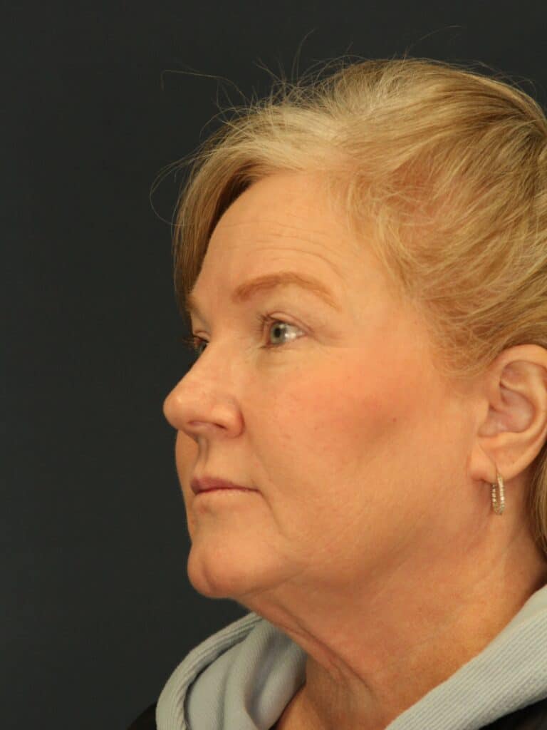 After Image: Upper Eyelid Lift & Facial Fat Grafting - left-back-oblique